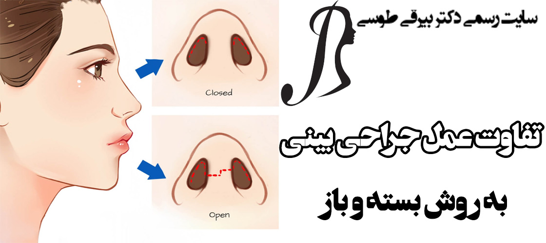 تفاوت عمل جراحی بینی به روش بسته و باز