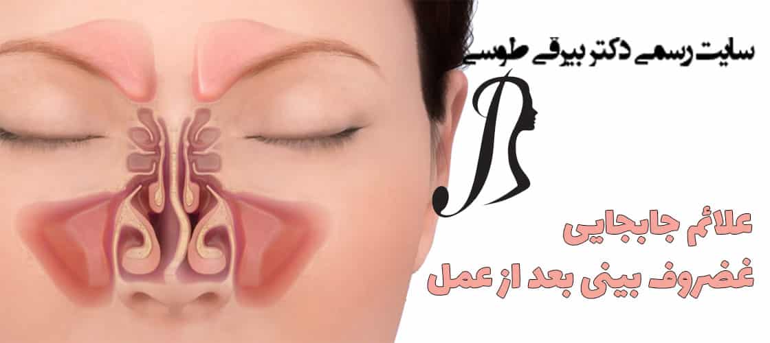 علائم جابجایی غضروف بینی بعد از عمل